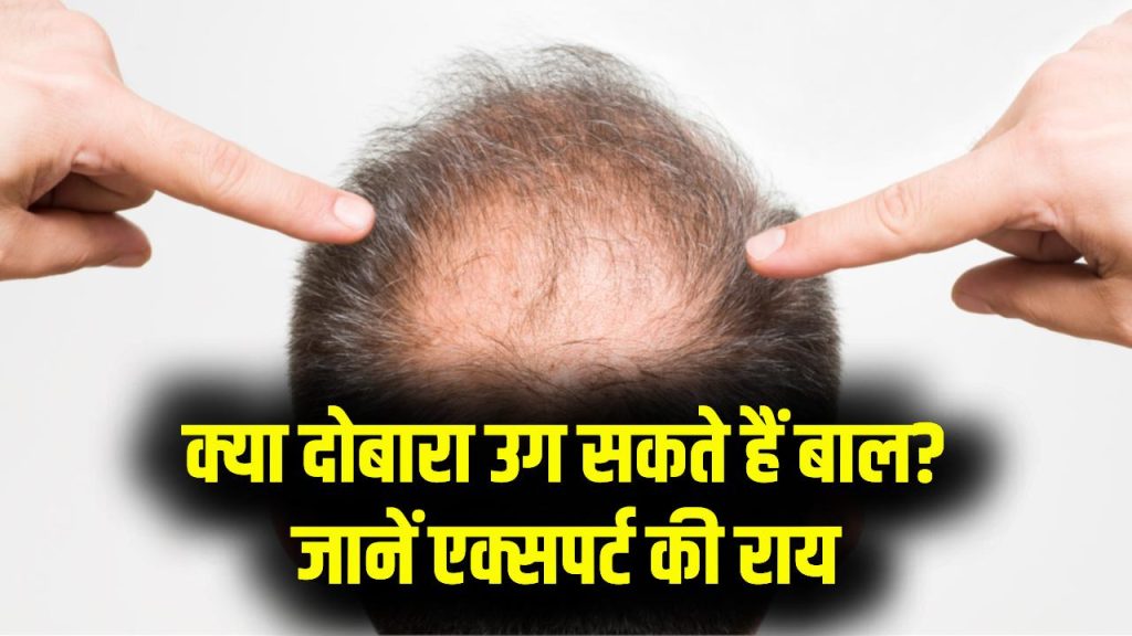 क्या गंजे सिर पर दोबारा बाल उगाना मुमकिन है? एक्सपर्ट ने बताया हेयर रीग्रोथ का वो तरीका जो सच में काम करता है 1 क्या गंजे सिर पर दोबारा बाल उगाना मुमकिन है? एक्सपर्ट ने बताया हेयर रीग्रोथ का वो तरीका जो सच में काम करता है